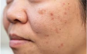10 Cara yang Bisa Hilangkan Bopeng Bekas Jerawat