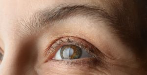 Kenali Gejala Katarak yang Jarang Disadari