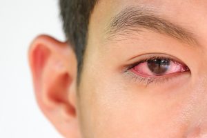 5 Tanaman Herbal yang Ampuh Sembuhkan Sakit Mata