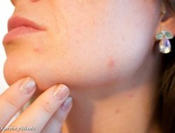 Yuk Kenali 6 Penyakit Kulit Umum yang Sering Dialami!