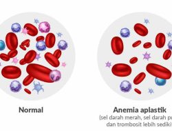 Mengenal Penyakit Langka, Anemia Aplastik yang Diderita Babe Cabita Sebelum Meninggal