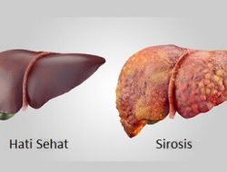 Mengenal Lebih Dekat dengan Penyakit Sirosis yang Menyerang Organ Hati