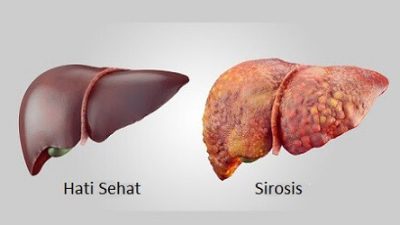 FDA Setujui Uji Klinis Penggunaan Hati Babi untuk Pengobatan Gagal Hati Akut