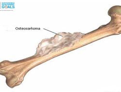 Mengenal Penyakit Osteosarkoma yang Diderita Warga Sukamelang Subang