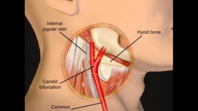 Mengenal Penyakit Penyumbatan Pembuluh Darah Arteri Karotis yang Dialami Aktor Sonny Septian