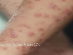 Waspada Situasi Darurat Global MPOX! 88 Kasus Mpox Terdeteksi di Indonesia