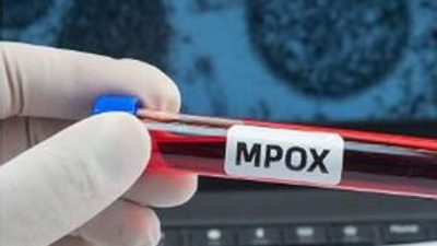 Terdeteksi Ada Kasus Mpox di Indonesia, Berikut Gejala dan Cara Mencegahnya!