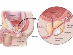 Tidak Hanya Paru dan Payudara, Ini Organ Lain yang Bisa Terkena Kanker