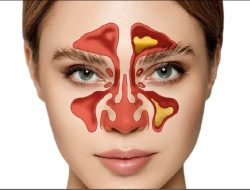 Kenali Gejala Sinusitis yang Perlu Diwaspadai