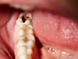 Masalah Karang Gigi dan Gigi Berlubang Masih Jadi PR Besar di RI