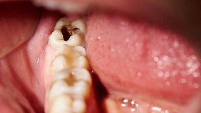 Masalah Karang Gigi dan Gigi Berlubang Masih Jadi PR Besar di RI