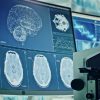 China Tanamkan Chip Otak dalam Uji Klinis Pertama, Pasien Mampu Kendalikan Perangkat dengan Pikiran