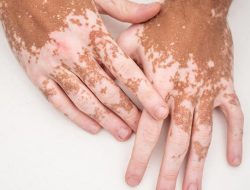 Mengenal Vitiligo, Penyakit Kulit yang Bisa Dikontrol Meski Tak Dapat Disembuhkan