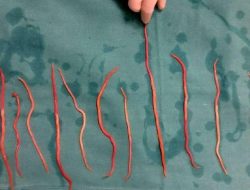 Dokter Ungkap Fakta Mengejutkan Dibalik Kasus Kematian Balita yang Tubuhnya Penuh Cacing