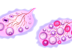 Ini Ciri-Ciri PCOS pada Wanita yang Paling Umum dan Mudah Dikenali!