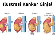 Mengenal Gejala Kanker Ginjal yang Merenggut Nyawa Musisi Vidi Aldiano