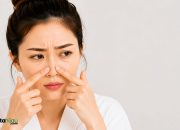 Cara Mengatasi Komedo Membandel di Hidung Tanpa Sakit, Kulit Bersih dengan Perawatan yang Tepat